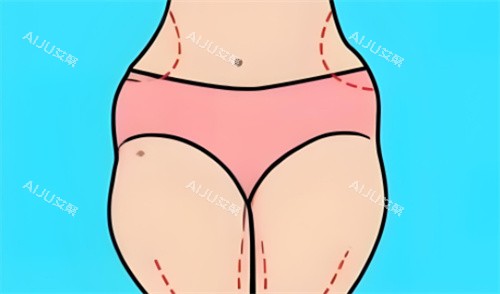 吸脂部位划线 吸脂部位划线