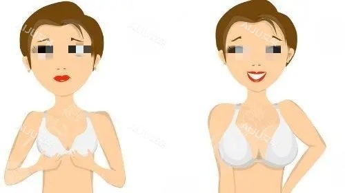 假体隆胸术后示意图 假体隆胸术后示意图