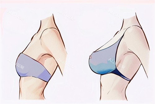 假体隆胸的前后对比图 假体隆胸的前后对比图