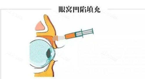 眼窝凹陷填充 眼窝凹陷填充