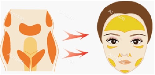 眼窝凹陷填充的步骤 眼窝凹陷填充的步骤