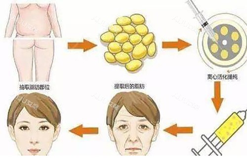 面部脂肪填充过程示意图 面部脂肪填充过程示意图