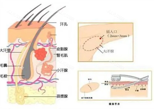 腋臭手术切口位置图解 腋臭手术切口位置图解