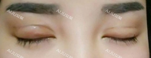 双眼皮失败照片