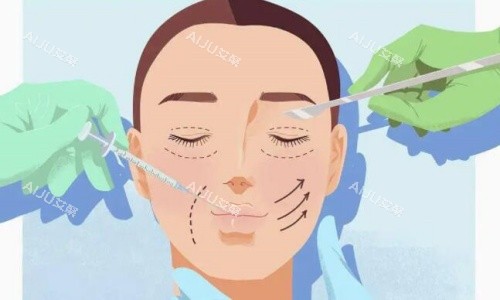 双眼皮手术操作示意图 双眼皮手术操作示意图