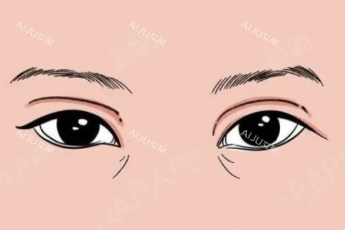 双眼皮失败卡通图 双眼皮失败卡通图