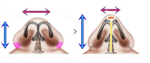 鼻翼缩小加隆鼻手术对比