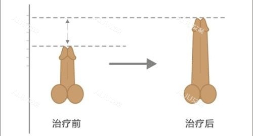 阴茎增长手术前后长度对比动画图 阴茎增长手术前后长度对比动画图