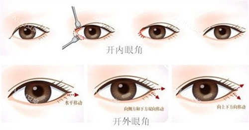 开眼角手术过程图