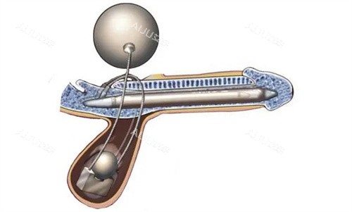 阴茎植入 阴茎植入