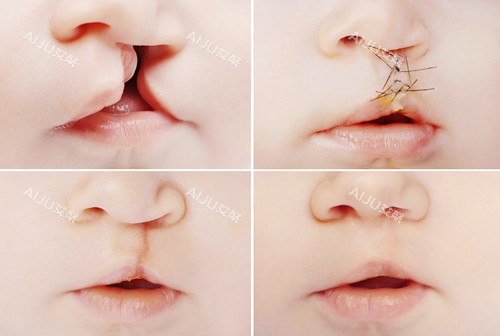 宝宝唇裂修复图示