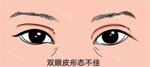 双眼皮修复示图