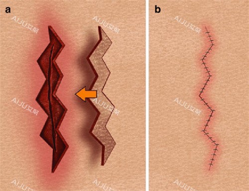 疤痕修复缝合