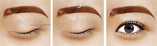 正在进行的双眼皮手术 正在进行的双眼皮手术