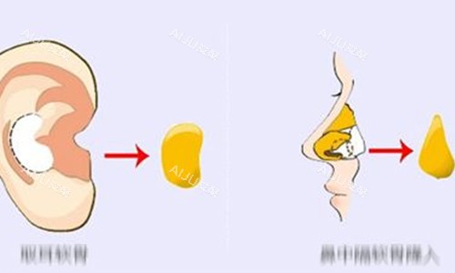 耳软骨隆鼻动画示意图