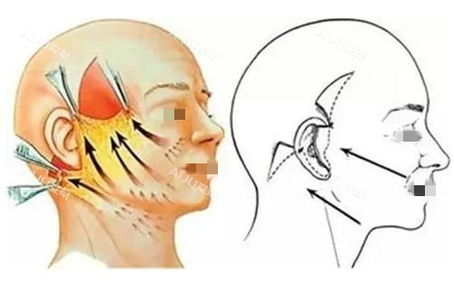 拉皮手术缝合前后示意图 拉皮手术缝合前后示意图