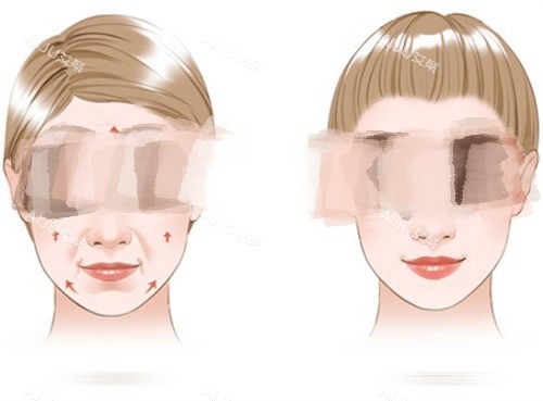 拉皮手术提拉方向示意图.jpg 拉皮手术提拉方向示意图.jpg