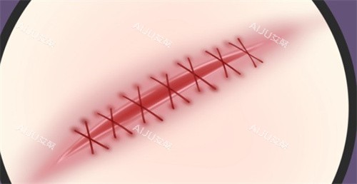 手术疤痕 手术疤痕