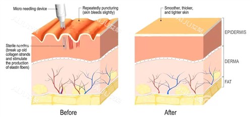 凹陷疤痕填充前后对比图 凹陷疤痕填充前后对比图