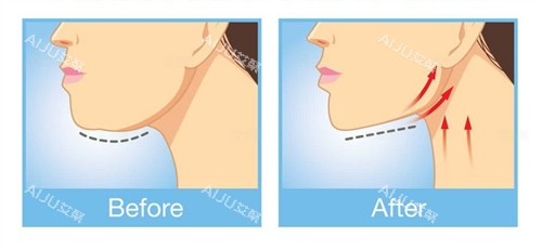 下巴提升紧致整形前后对比图 下巴提升紧致整形前后对比图