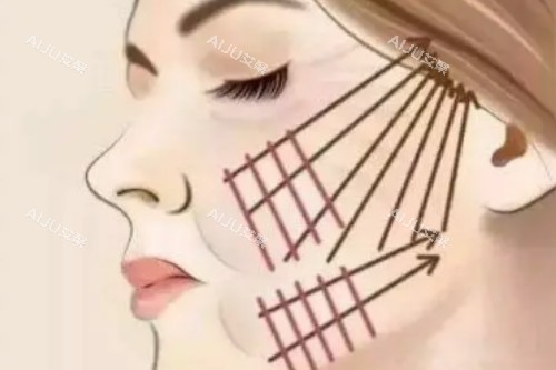 埋线提升卡通图片展示 埋线提升卡通图片展示