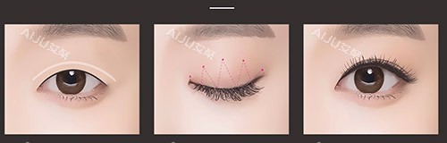 埋线双眼皮过程示意图