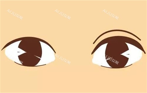 双眼皮手术的前后对比