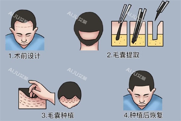 植发手术 植发手术