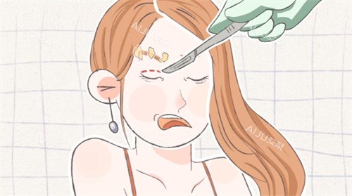 双眼皮手术失败修复卡通图片 双眼皮手术失败修复卡通图片