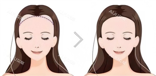 植发前后对比卡通图 植发前后对比卡通图