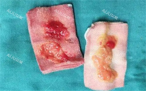 太阳穴取出的生长因子 太阳穴取出的生长因子