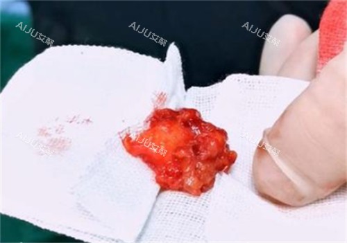 下巴取出的生长因子 下巴取出的生长因子