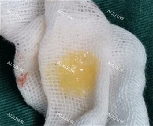 生长因子刚刚注射后取出的样子 生长因子刚刚注射后取出的样子