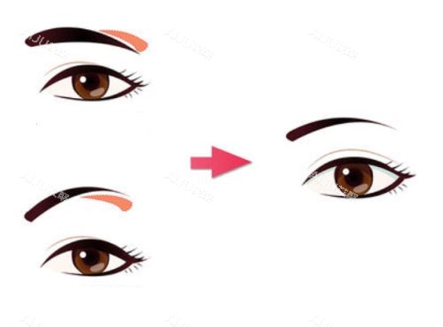 提眉手术前后对比图 提眉手术前后对比图