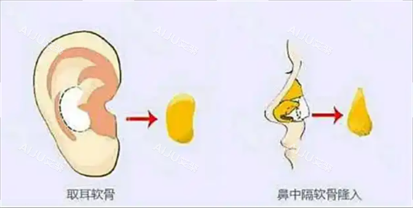 耳软骨隆鼻 耳软骨隆鼻