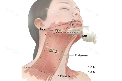 下颌缘和颈阔肌示意图 下颌缘和颈阔肌示意图
