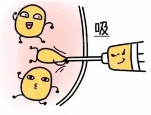 吸脂手术动画 吸脂手术动画