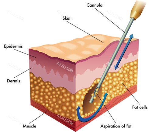 吸脂手术动画图示 吸脂手术动画图示