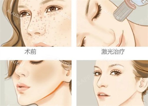 激光祛斑术前术后对比 激光祛斑术前术后对比