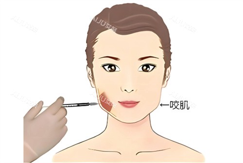 打针瘦脸 打针瘦脸