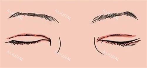 双眼皮疤痕修复 双眼皮疤痕修复