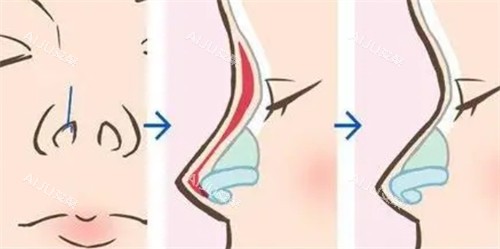 隆鼻手术过程 隆鼻手术过程