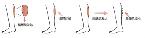 注射瘦腿过程 注射瘦腿过程