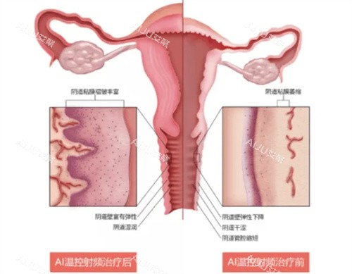 半岛FemeTite私密热玛吉功效