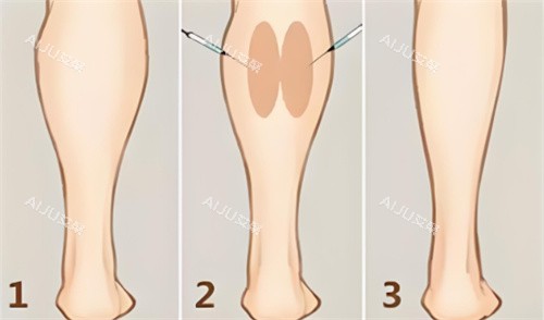 注射瘦小腿对比