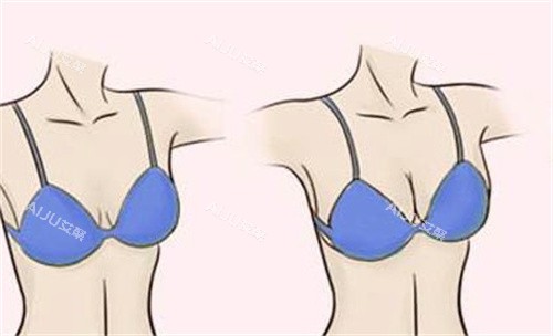 隆胸***对比 隆胸***对比