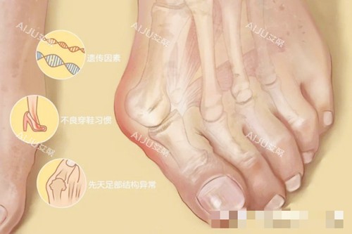 大脚骨图示 大脚骨图示