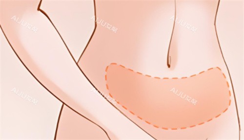吸脂腹部区域 吸脂腹部区域