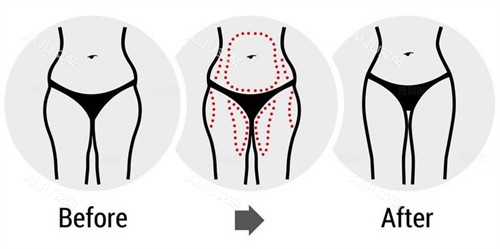 腰腹大腿吸脂前后对比图 腰腹大腿吸脂前后对比图