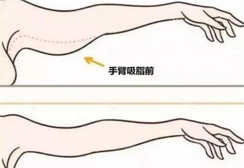 手臂吸脂 手臂吸脂